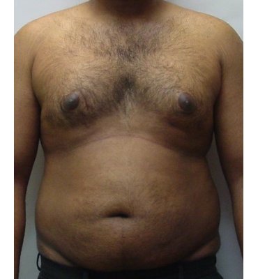 gynecomastio before